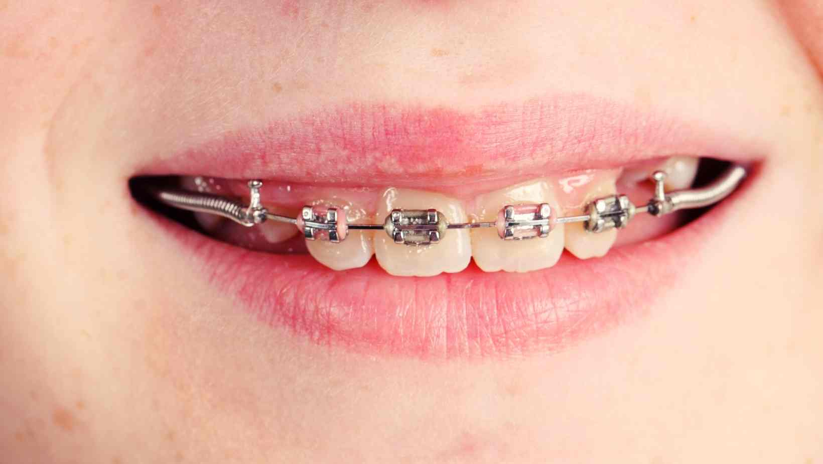 Lingual Braces